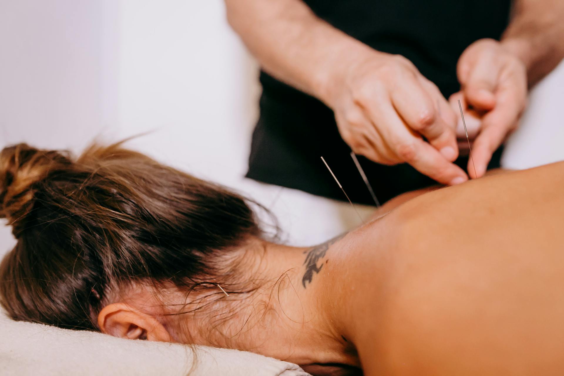 Acupuncture (Zhen)